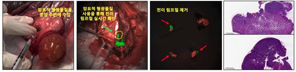암표적 형광물질을 이용한 전이림프절 확인 및 제거