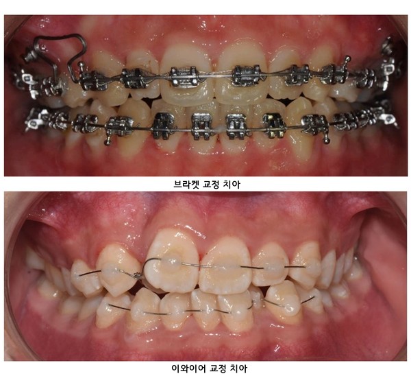 브라켓, 이와이어 교정 치아