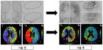 병합 치료 후 뇌혈관 조영술에서 혈관재생을 보이는 사진(위) 및 관류 CT 사진에서 혈류개선을 보였던 환자 영상(아래).