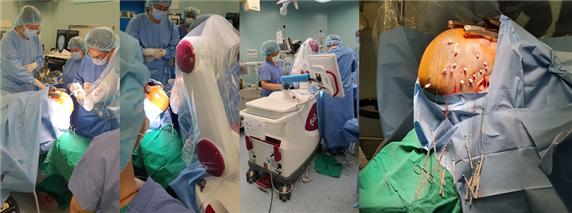 ROSA 수술로봇을 이용해 SEEG 심부전극을 삽입하는 과정과 14개 전극이 삽입된 모습