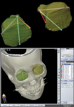 신호성 교수팀이 안와골절 치료에 활용한 3차원 시뮬레이션 프로그램 모습