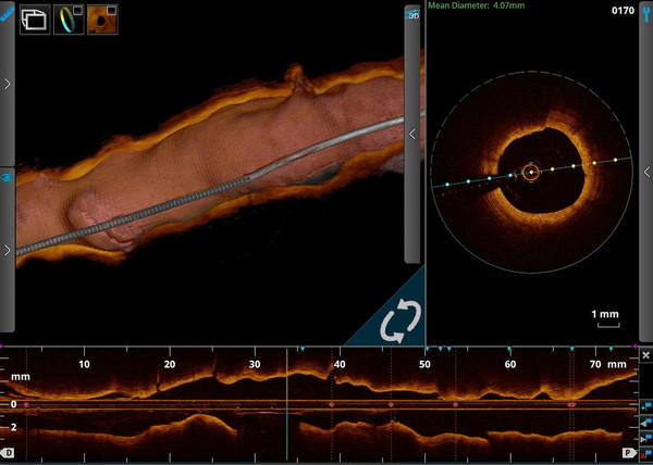 광간섭단층촬영(OCT)을 통해 3차원으로 살펴본 심장혈관 이미지