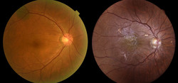 정상(왼쪽)과 망막앞막 환자(오른쪽)의 안저사진. 황반부에 하얀 반투명막과 이로 인한 망막전층의 주름 및 혈관 변형이 관찰된다.