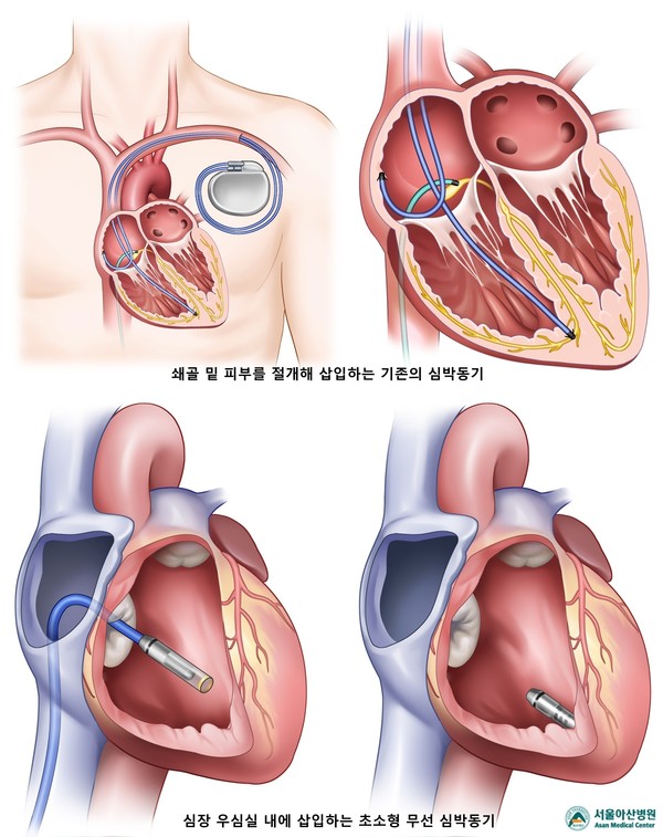 기존의 심박동기(위)와 무선 심박동기(아래) 시술 과정