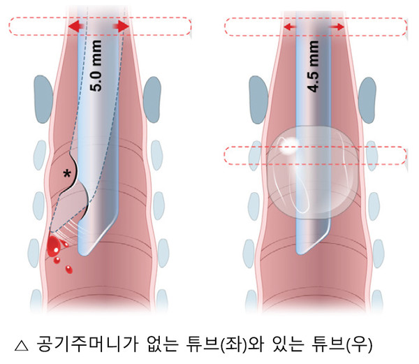공기주머니가 없는 튜브(왼쪽)는 몸통이 후두의 후방에 강한 압력을 주고, 앞으로 공기가 샐 수 있으며, 튜브 끝이 기관(trachea) 점막에 손상을 준다. 반면 공기주머니가 있는 튜브(오른쪽), 특히, 폴리우레탄 재질은 후방에 작은 압력을 주고, 앞으로 새는 공기가 적으며, 공기주머니가 튜브 끝과 기관을 서로 분리한다. 또 공기주머니가 다소 과다 팽창되더라도 기관이 뒤쪽으로 팽창하는 성질이 있어서 손상이 적다.